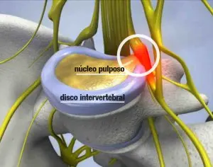Representação anatômica de hérnia de disco comprimindo nervo